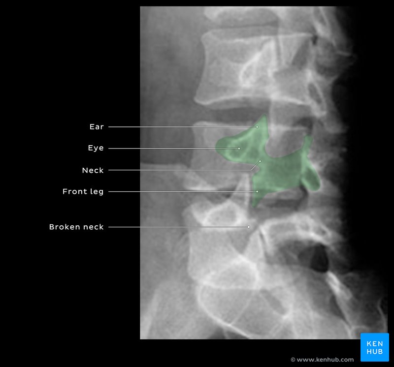 Fractured pars interarticularis ('Scottie dog' sign)