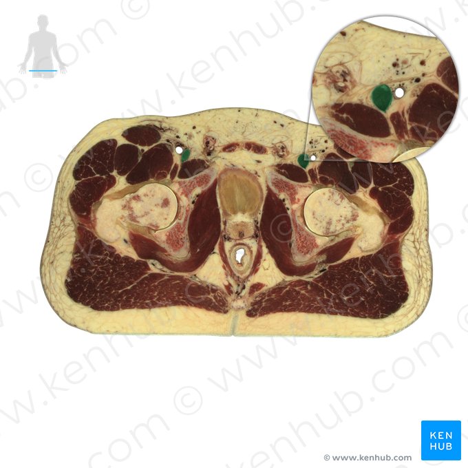 Femoral vein (Vena femoralis); Image: National Library of Medicine