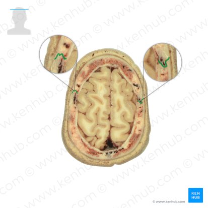 Coronal suture (Sutura coronalis); Image: National Library of Medicine