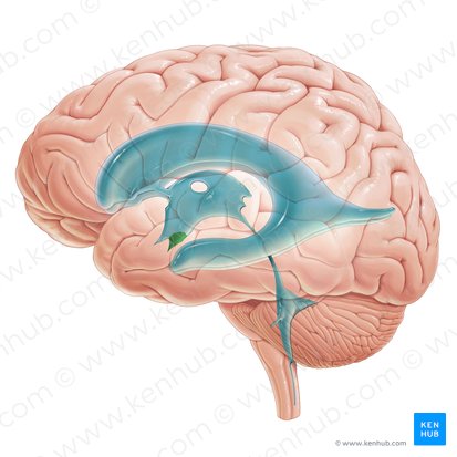 Recessus infundibuli ventriculi tertii (Trichterförmige Ausbuchtung des dritten Ventrikels); Bild: Paul Kim