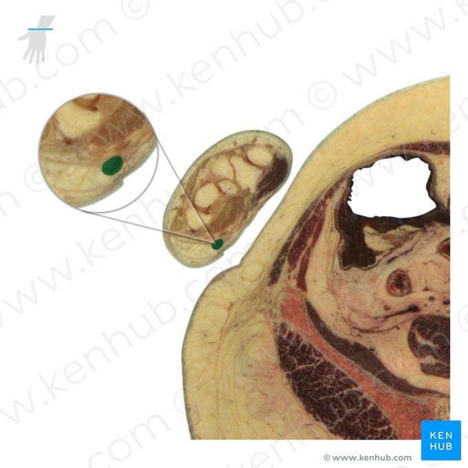 Tendão do músculo flexor ulnar do carpo (Tendo musculi flexoris carpi ulnaris); Imagem: National Library of Medicine