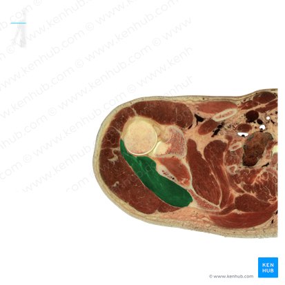Musculus infraspinatus (Untergrätenmuskel); Bild: National Library of Medicine