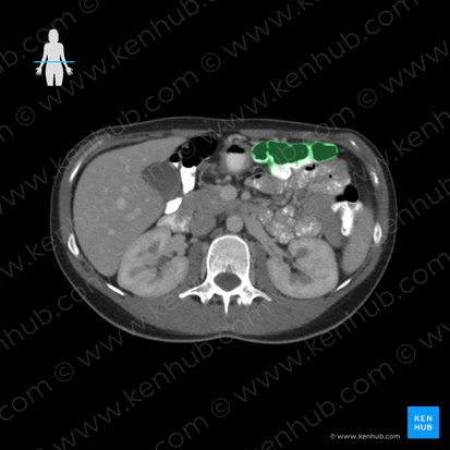 Colon transverse (Colon transversum); Image : 