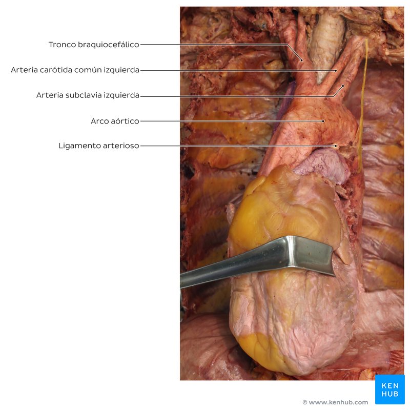 Corazón y ligamento arterioso en un cadáver.