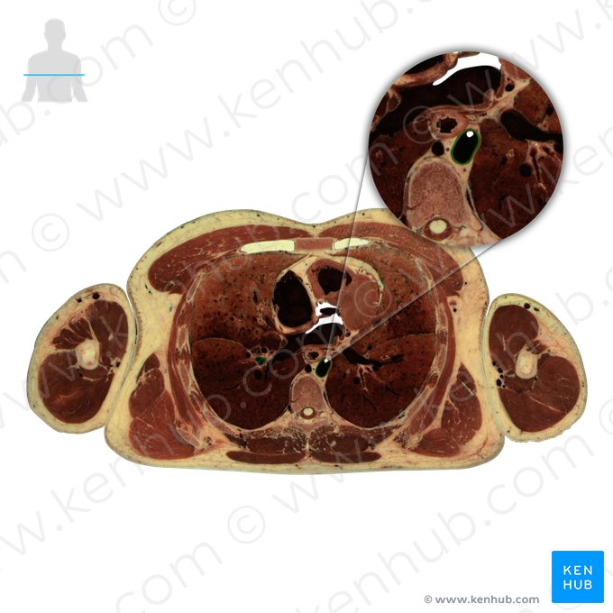 Aorta descendente (Aorta descendens); Imagem: National Library of Medicine