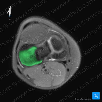 Lateral condyle of tibia (Condylus lateralis tibiae); Image: 