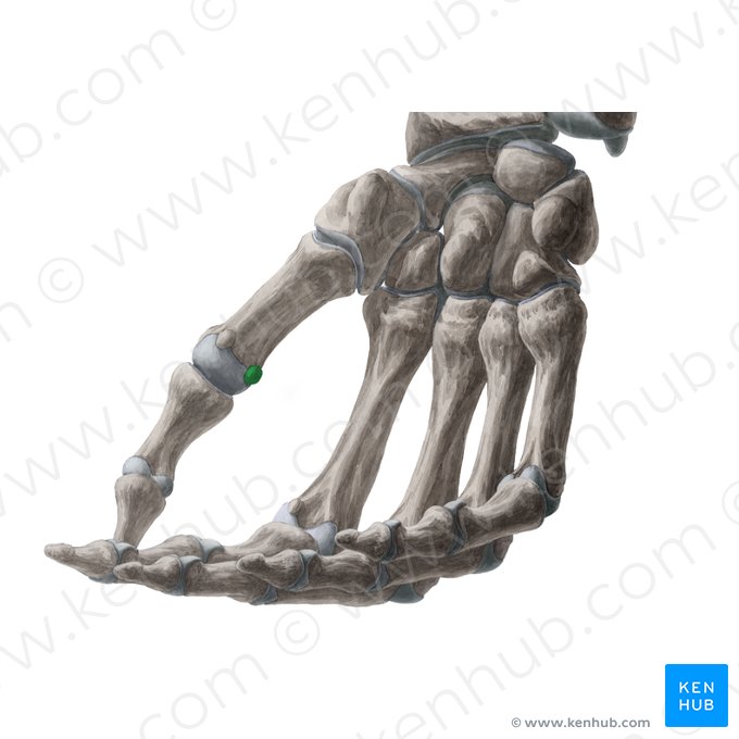 Os sesamoideum ulnare articulationis metacarpophalangeae pollicis (Ellenseitiges Sesambein des Daumens); Bild: Yousun Koh