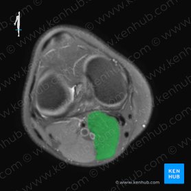 Medial head of gastrocnemius muscle (Caput mediale musculi gastrocnemii); Image: 