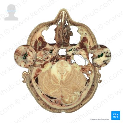 Plexus venosus pterygoideus (Flügelvenengeflecht); Bild: National Library of Medicine