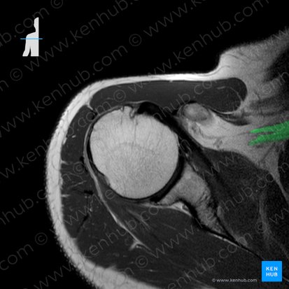 Plexus brachialis (Armgeflecht); Bild: 