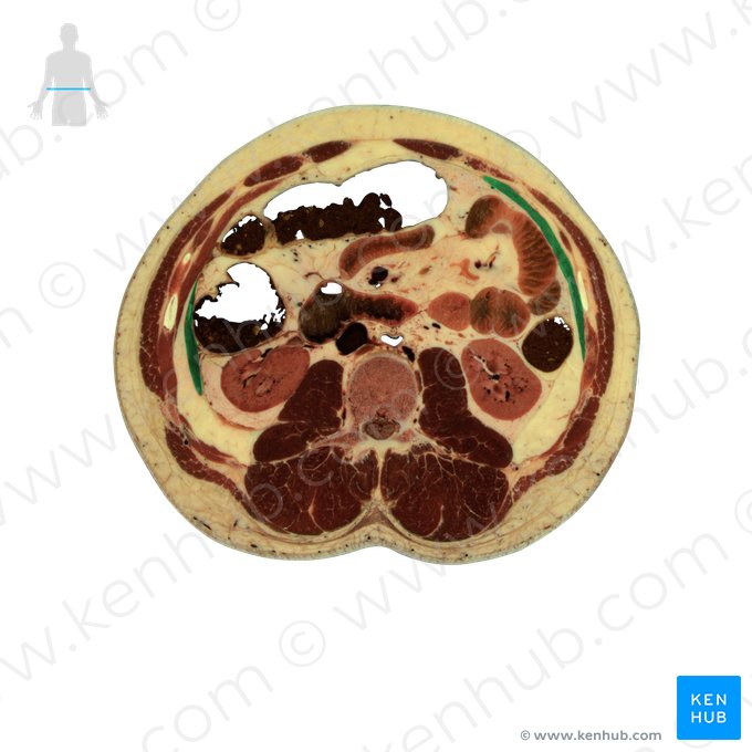 Músculo transverso do abdome (Musculus transversus abdominis); Imagem: National Library of Medicine