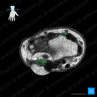 Tendon of extensor pollicis longus muscle (Tendo musculi extensoris pollicis longi); Image: 