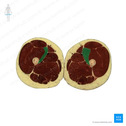 Vastus medialis muscle (Musculus vastus medialis); Image: National Library of Medicine