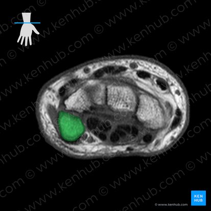 Pisiform bone (Os pisiforme); Image: 