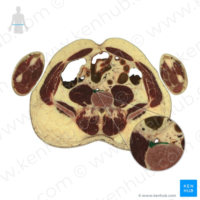 Veia cava inferior (Vena cava inferior); Imagem: National Library of Medicine