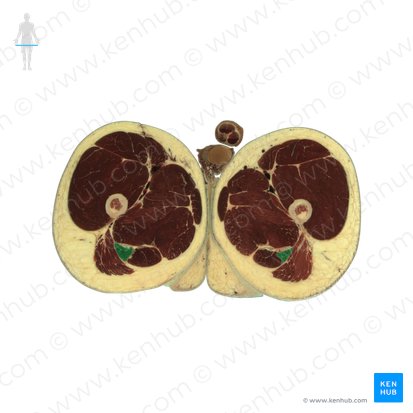 Musculus biceps femoris (Zweiköpfiger Oberschenkelmuskel); Bild: National Library of Medicine