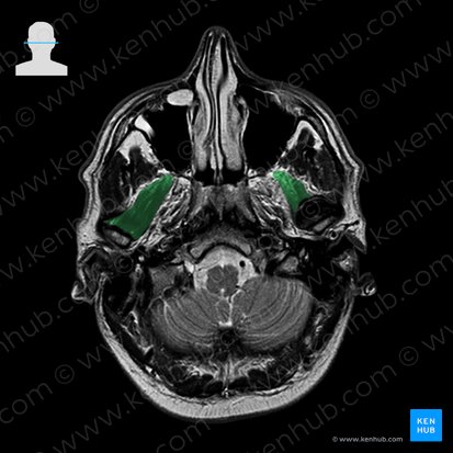 Músculo pterigoideo lateral (Musculus pterygoideus lateralis); Imagen: 