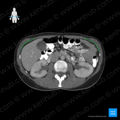 Musculus transversus abdominis (Querer Bauchmuskel); Bild: 