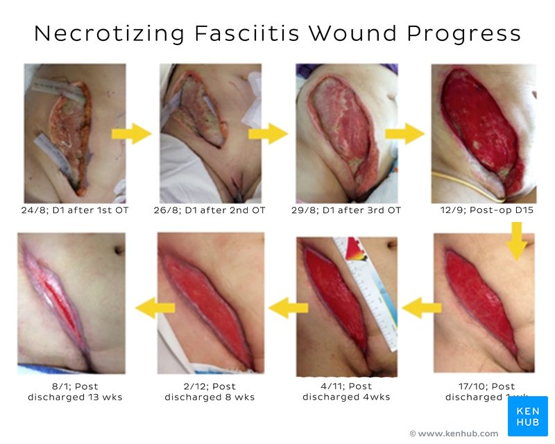 Necrotizing fasciits wound healing