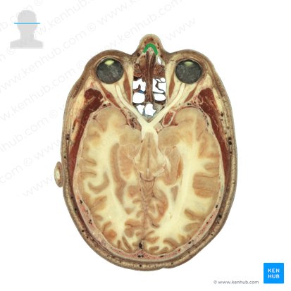 Osso nasal (Os nasale); Imagem: National Library of Medicine