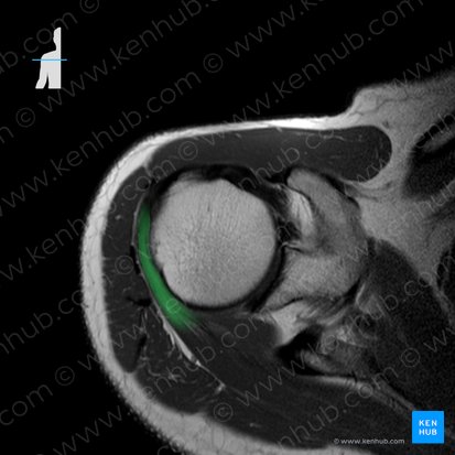 Tendão do músculo infraespinal (Tendo musculi infraspinati); Imagem: 