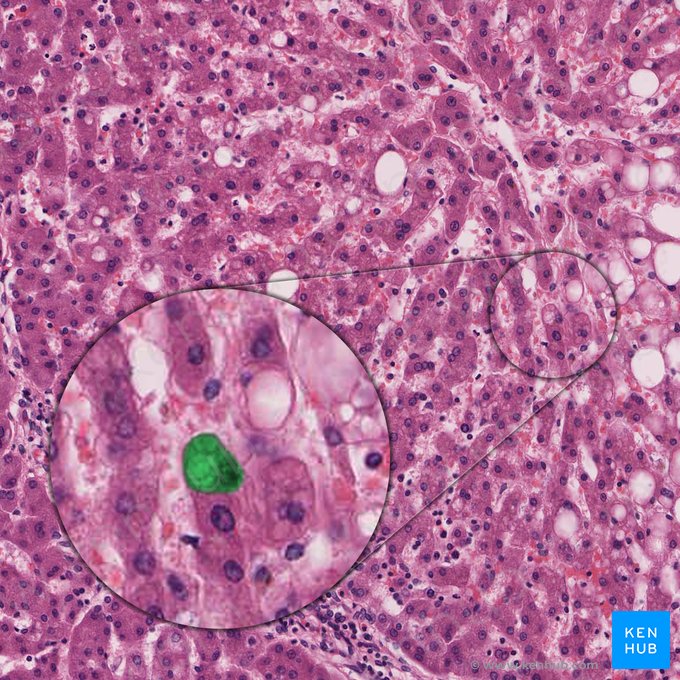 Hepatocito esteatótico (Hepatocytus steatoticus); Imagen: 