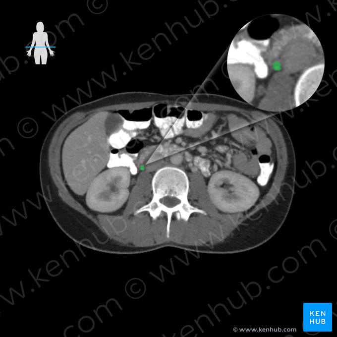 Right ovarian vein (Vena ovarica dextra); Image: 