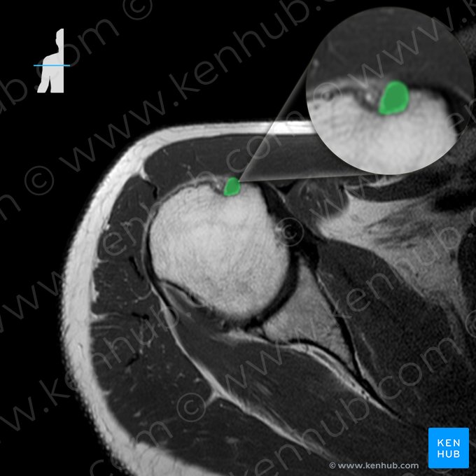 Tendón de la cabeza larga del músculo bíceps braquial (Tendo capitis longi musculi bicipitis brachii); Imagen: 