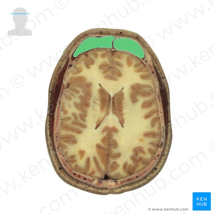 Frontal sinus (Sinus frontalis); Image: National Library of Medicine