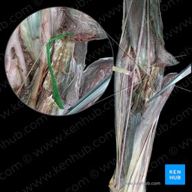 Ramos musculares del nervio mediano para el músculo flexor radial del carpo (Rami musculares nervi mediani cum musculus flexor carpi radialis); Imagen: 