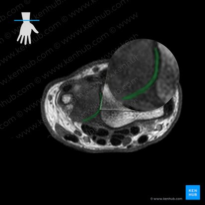 Articulatio radioulnaris distalis (Körperfernes Speichen-Ellen-Gelenk); Bild: 