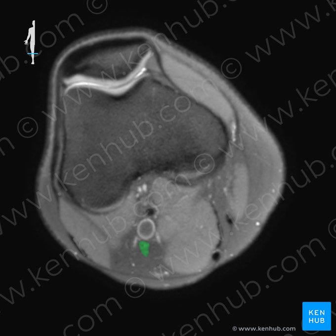 Nervo tibial (Nervus tibialis); Imagem: 