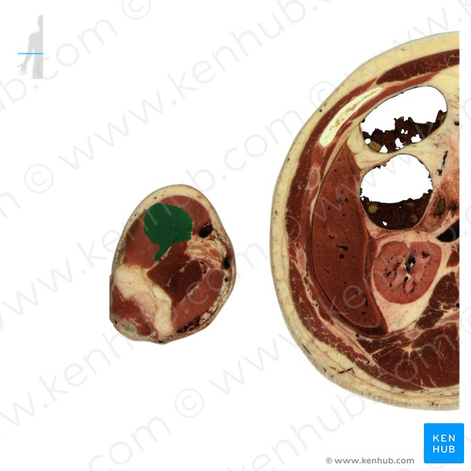 Músculo extensor radial longo do carpo (Musculus extensor carpi radialis longus); Imagem: National Library of Medicine