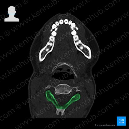 Vertebral arch (Arcus vertebrae); Image: 