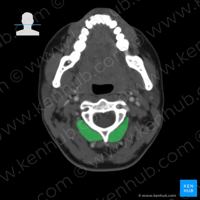 Musculus obliquus capitis inferior (Unterer schräger Kopfmuskel); Bild: 