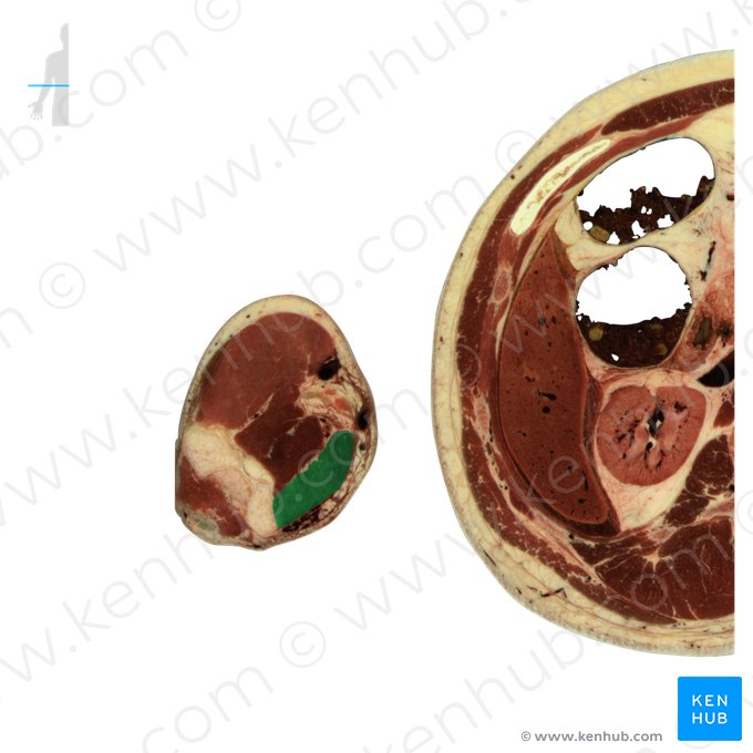 Musculus pronator teres (Runder Einwärtsdreher); Bild: National Library of Medicine