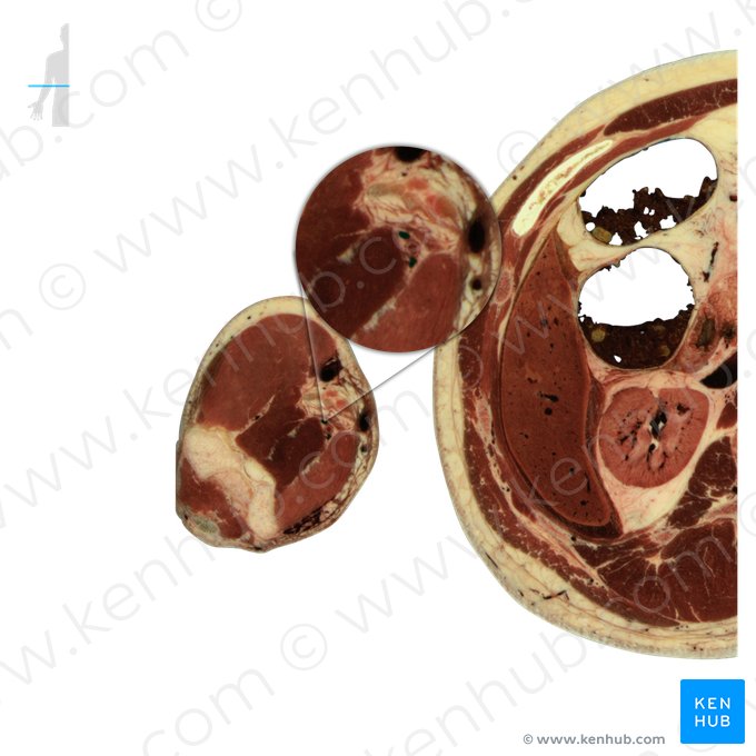 Venae brachiales (Oberarmvenen); Bild: National Library of Medicine