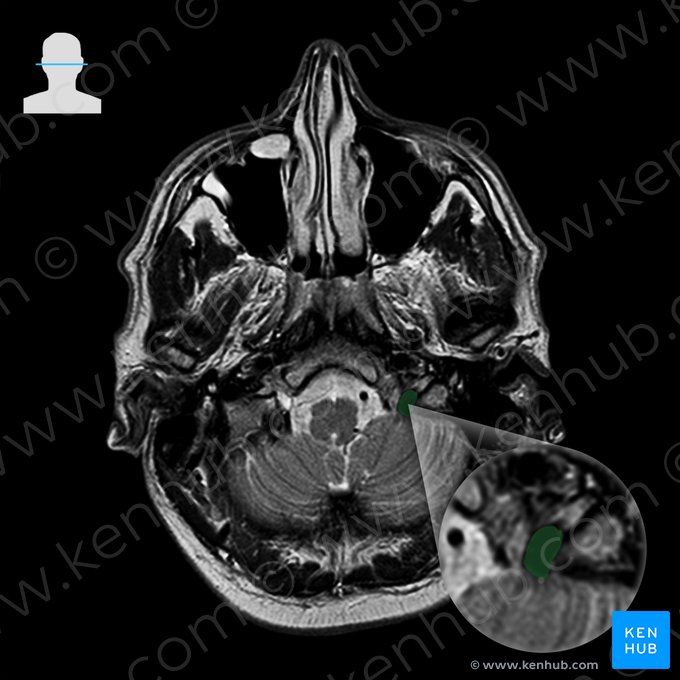 Seno sigmoideo (Sinus sigmoideus); Imagen: 