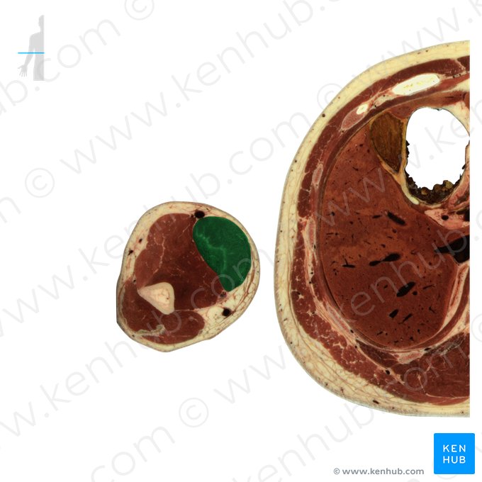 Musculus biceps brachii (Zweiköpfiger Oberarmmuskel); Bild: National Library of Medicine