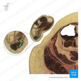 Musculus palmaris brevis (Kurzer Hohlhandmuskel); Bild: National Library of Medicine