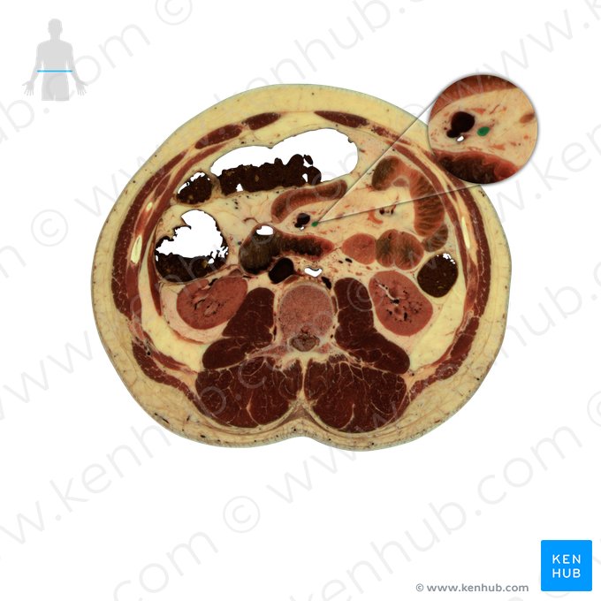 Arteria mesenterica superior (Obere Eingeweidearterie); Bild: National Library of Medicine