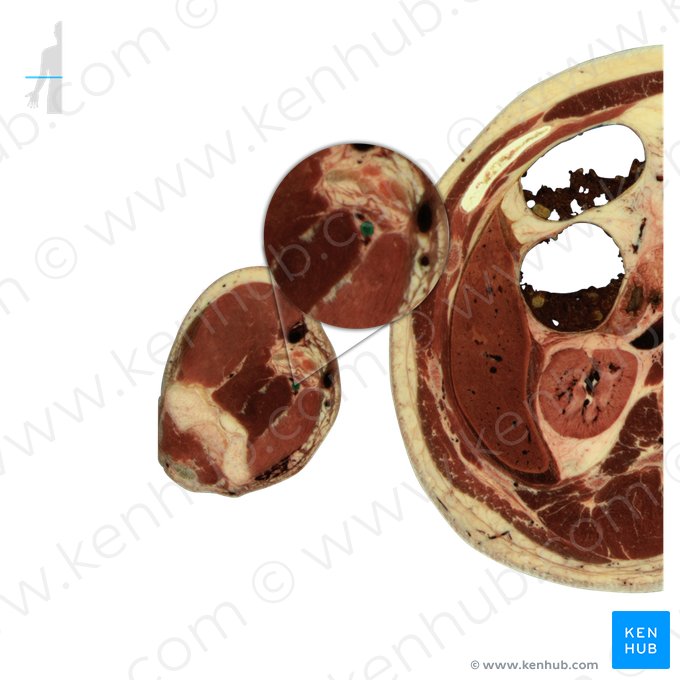 Brachial artery (Arteria brachialis); Image: National Library of Medicine