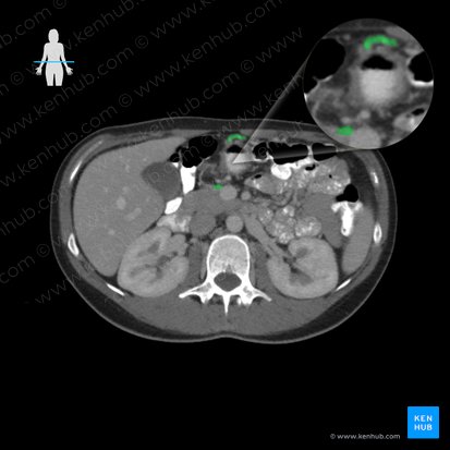 Vena gastroomentalis dextra (Rechte Magen-Netz-Vene); Bild: 