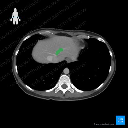 Left hepatic vein (Vena hepatica sinistra); Image: 