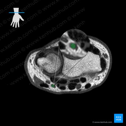 Arteria ulnaris (Ellenarterie); Bild: 