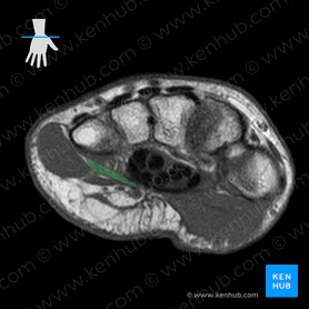 Opponens digiti minimi muscle of hand (Musculus opponens digiti minimi manus); Image: 