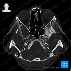 Frontozygomatic suture (Sutura frontozygomatica); Image: 