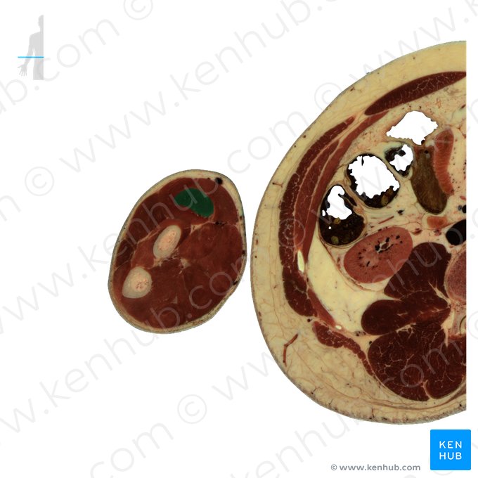 Músculo extensor radial longo do carpo (Musculus extensor carpi radialis longus); Imagem: National Library of Medicine