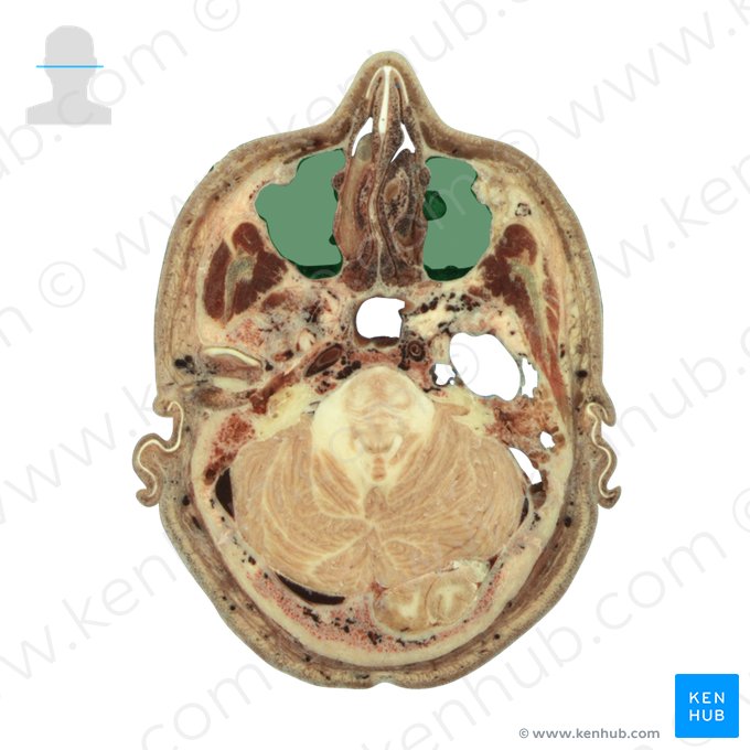 Seio maxilar (Sinus maxillaris); Imagem: National Library of Medicine