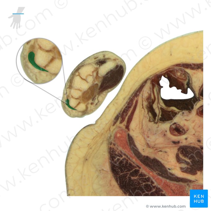 Tendão do músculo extensor ulnar do carpo (Tendo musculi extensoris carpi ulnaris); Imagem: National Library of Medicine